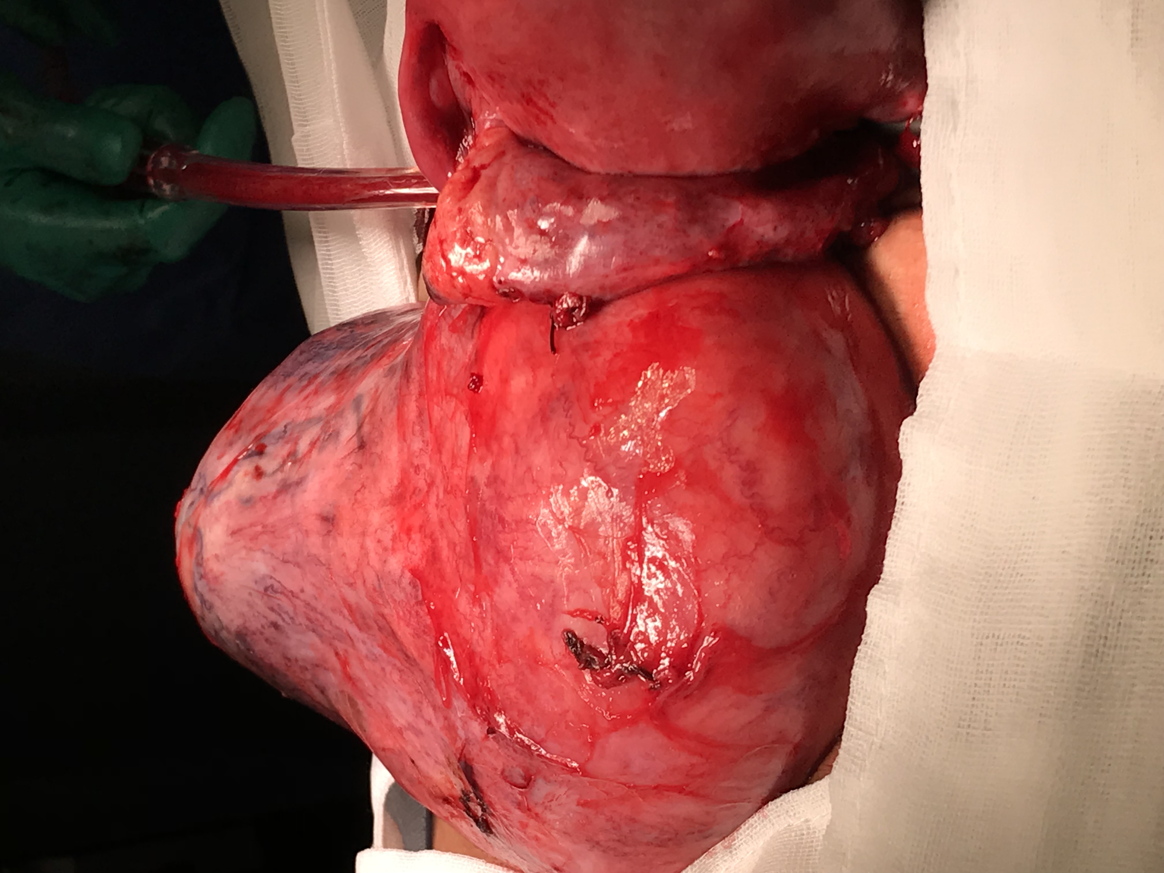 Dr Serag Youssif Fibroid Very Large Herniating Through Pelvic Floor1